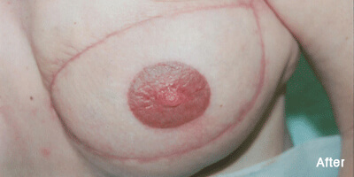 Areola and Scar Repigmentation