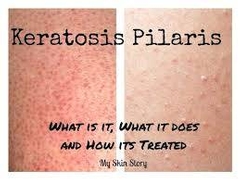 What is Keratosis Pilaris and How Can I Treat It?