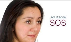 How to treat adult acne